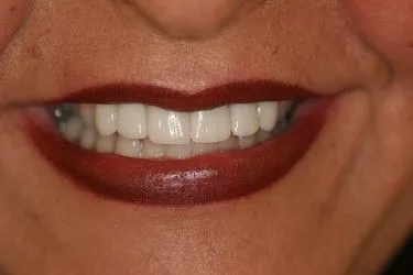 After smile transformation – Case 1