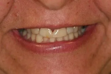 Before smile transformation – Case 1