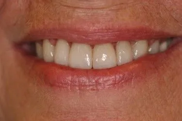 After smile transformation – Case 2