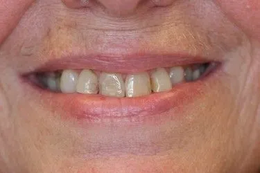 Before smile transformation – Case 2