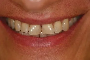 Before smile transformation – Case 3