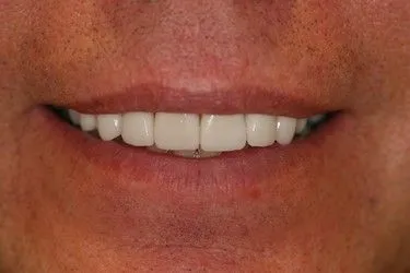 After smile transformation – Case 4