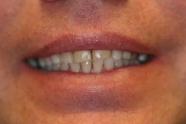 Before smile transformation – Case 4