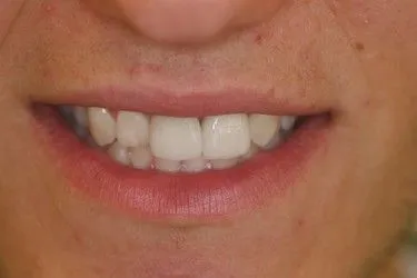After smile transformation – Case 5
