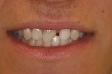 Before smile transformation – Case 5