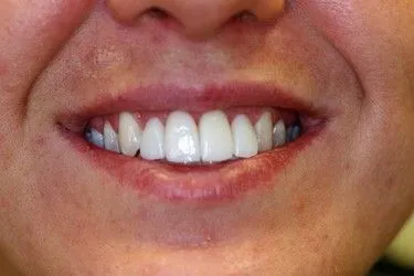 After smile transformation – Case 6