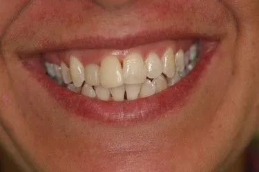 Before smile transformation – Case 6