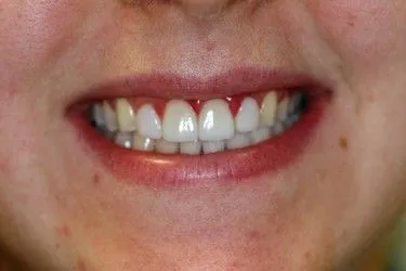 After smile transformation – Case 7