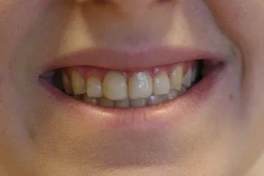 Before smile transformation – Case 7