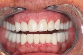 After smile transformation – Case 9