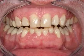 Before smile transformation – Case 9