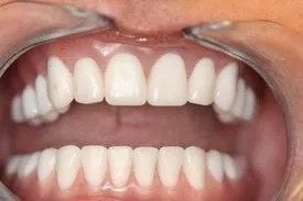 After smile transformation – Case 10