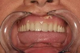 Before smile transformation – Case 10