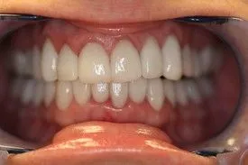 After smile transformation – Case 11