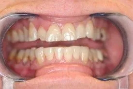 Before smile transformation – Case 11