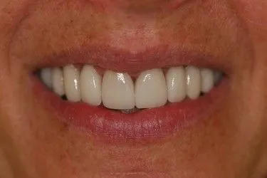 After smile transformation – Case 12