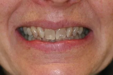 Before smile transformation – Case 12