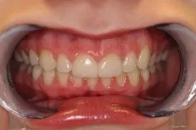 After smile transformation – Case 13