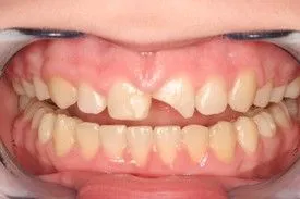 Before smile transformation – Case 13