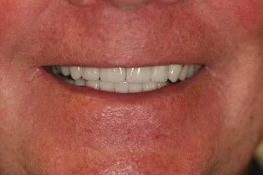 After smile transformation – Case 14