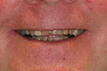 Before smile transformation – Case 14
