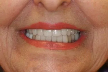 After smile transformation – Case 15