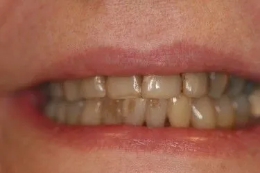 Before smile transformation – Case 15