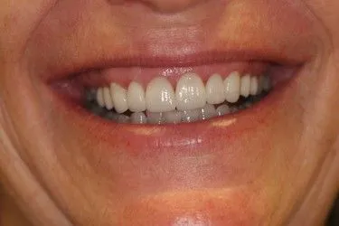 After smile transformation – Case 16