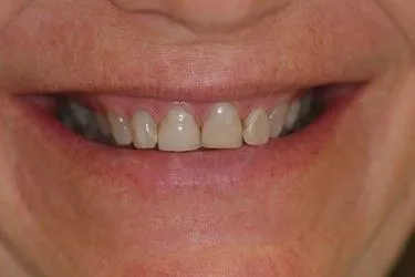 Before smile transformation – Case 16