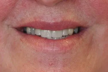 After smile transformation – Case 17