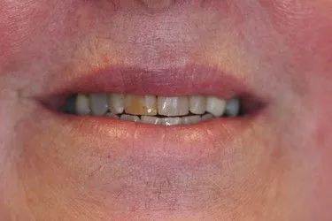 Before smile transformation – Case 17