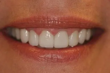 After smile transformation – Case 18