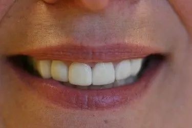 Before smile transformation – Case 18