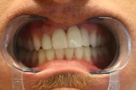 After smile transformation – Case 19