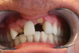 Before smile transformation – Case 19