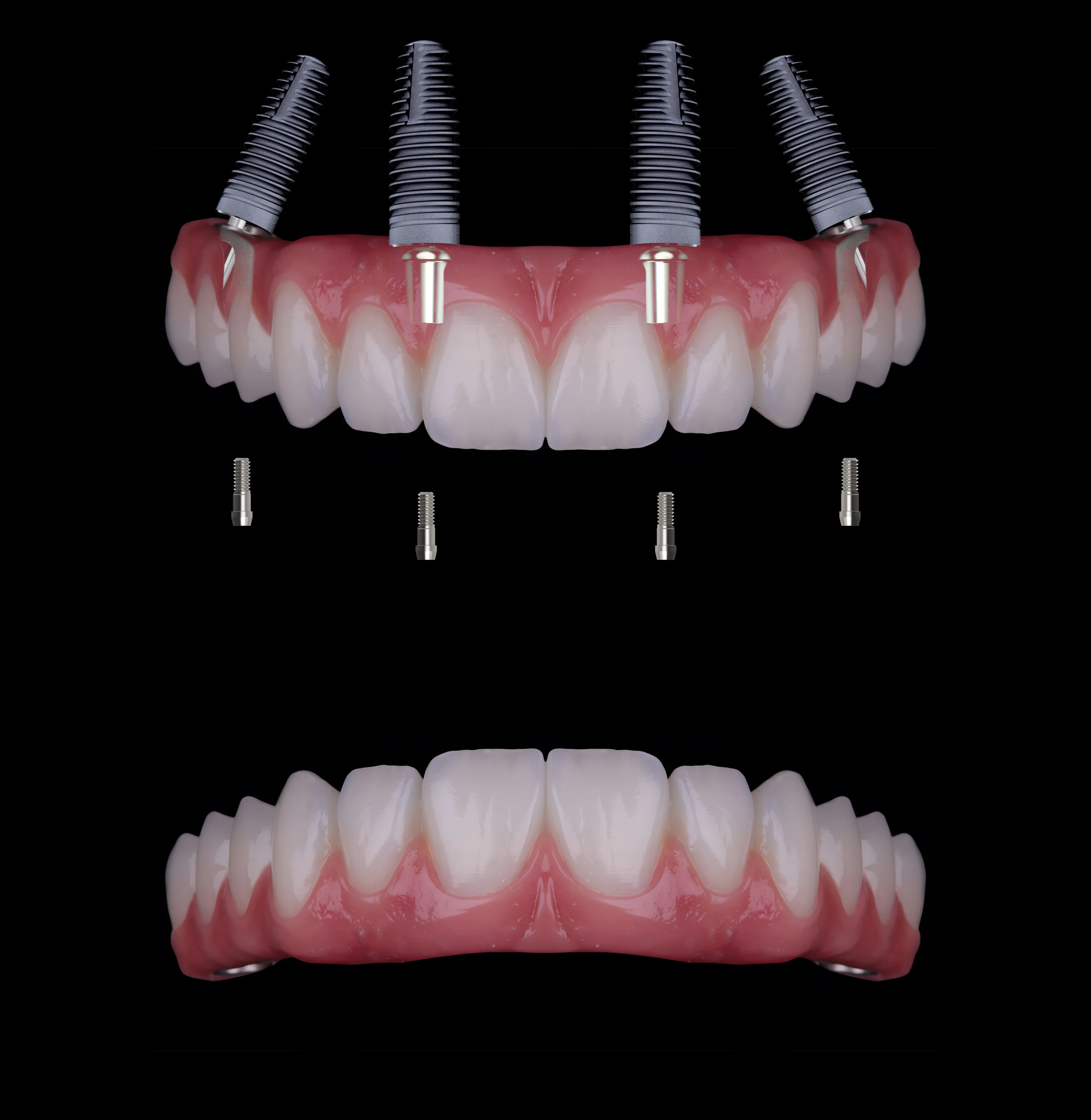 All-on-4 dental implant supported teeth