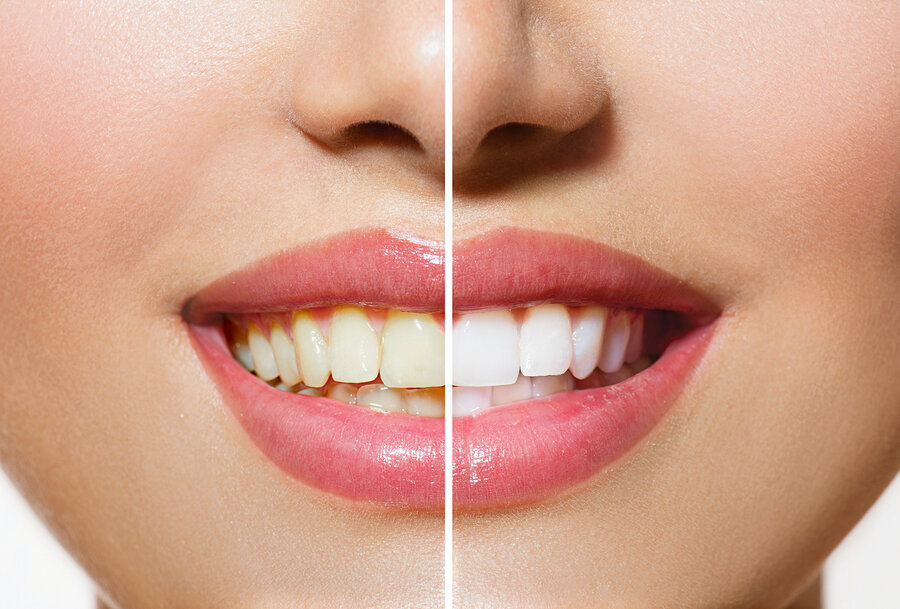 Before and after teeth whitening North Canton