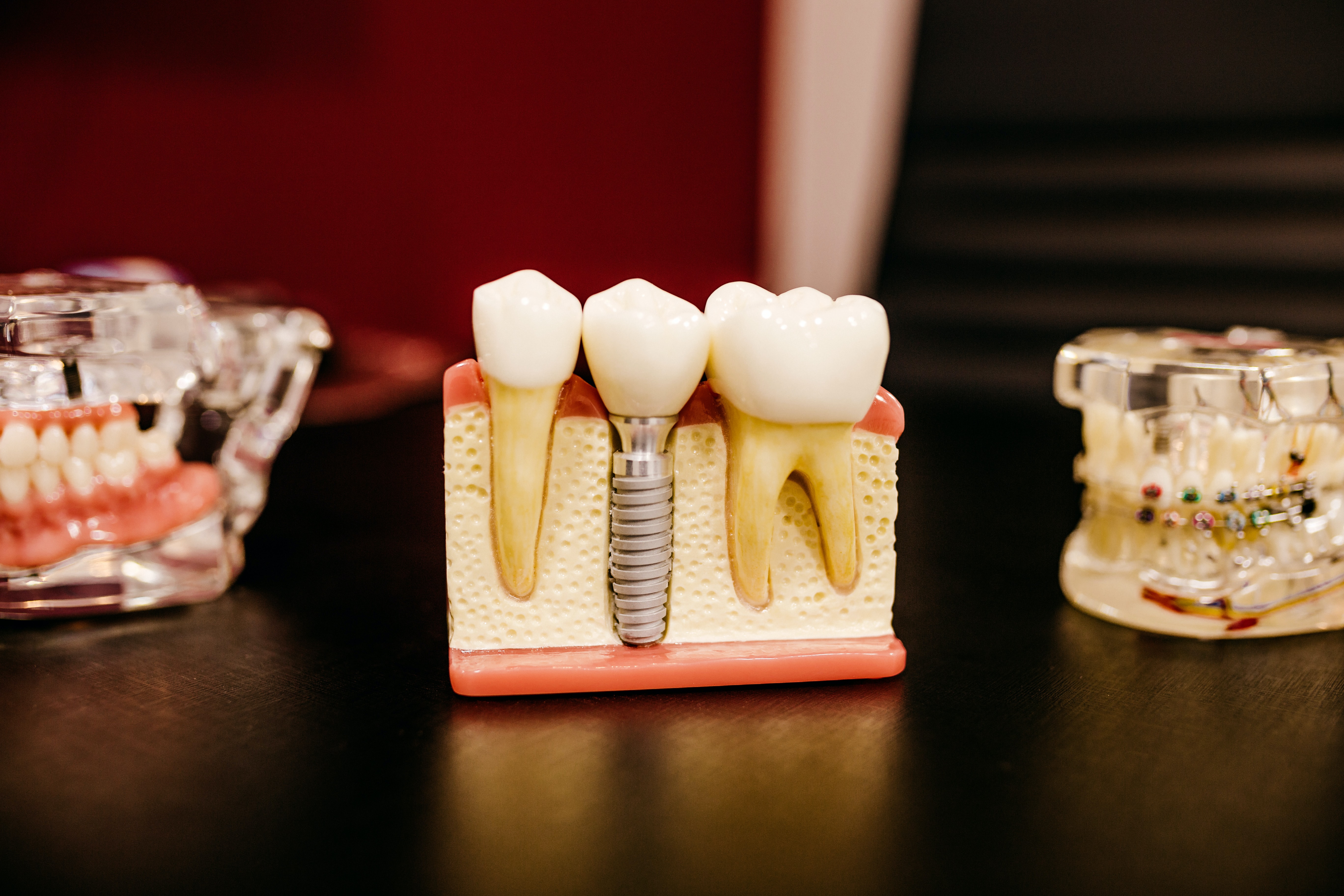 Dental Implants in North Canton, OH